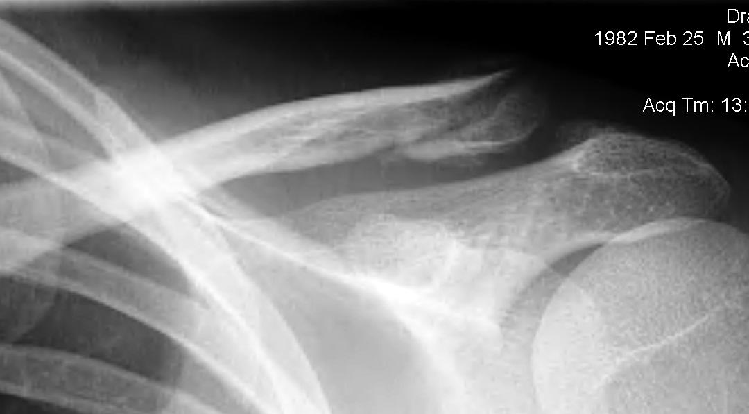 Lateral Clavicle Fracture Undisplaced
